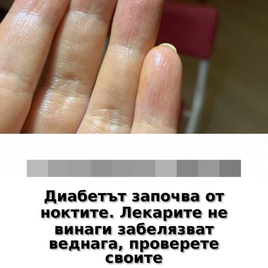 Диабетът започва от ноктите. Лекарите не винаги го забелязват веднага – проверете своите. 👇 1 554080798 1350364550433097 8232254164609065837 n